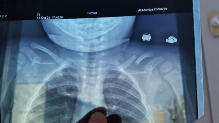 Врачи лечили перелом ключицы 2-летней девочки в Чите с помощью геля – Mash
