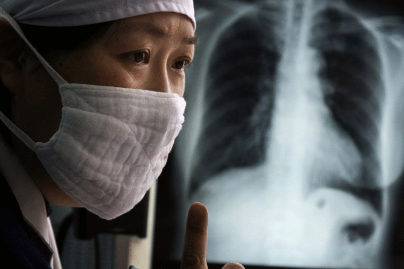 Переболевшие COVID-пневмонией попали в группу риска заражения туберкулёзом