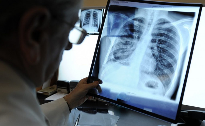 Четверо жителей Нерчинского района принудительно пройдут обследование на туберкулёз